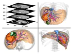 Clinical decision system development for paediatric liver tumour surgery