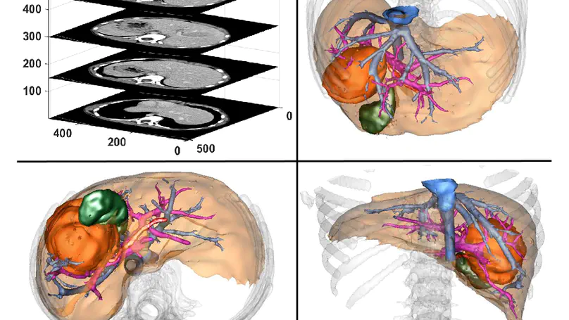 Clinical decision system development for paediatric liver tumour surgery
