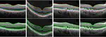 Development and application of variational techniques for segmentation and quantification of optical coherence tomography images