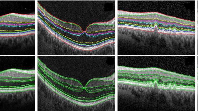 Development and application of variational techniques for segmentation and quantification of optical coherence tomography images