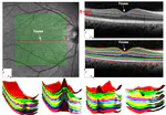 Automated segmentation of retinal layers from optical coherent tomography images using geodesic distance