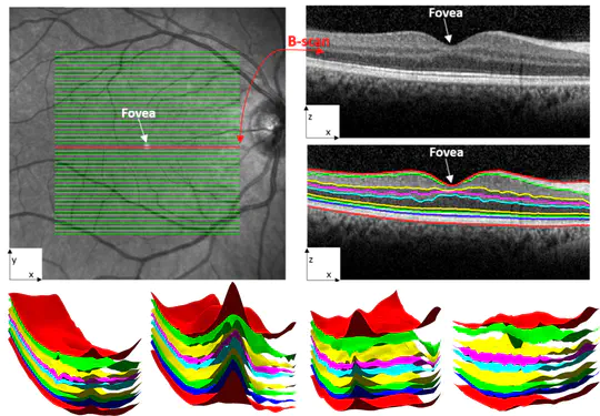Automated segmentation of retinal layers from optical coherent tomography images using geodesic distance